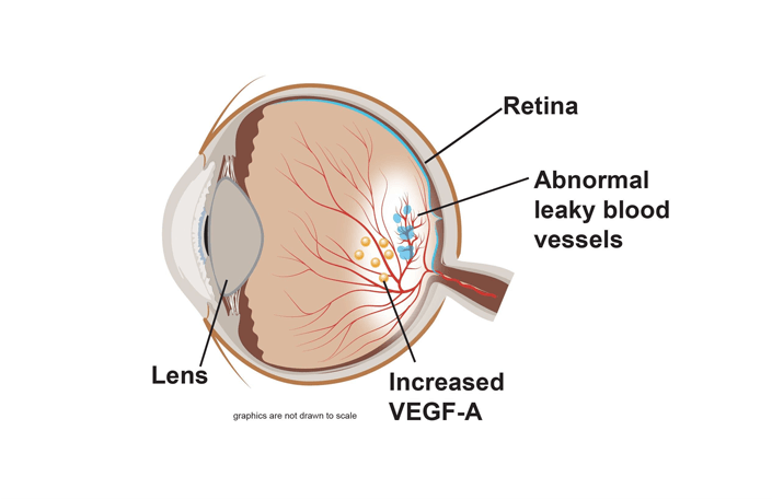 Picture: O.C.T. scan with no visible retinal fluid