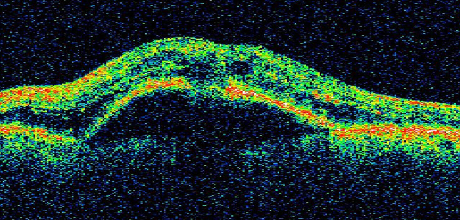 Picture: Illustration of anatomy of an eye with wet AMD, identifying the lens, retina, abnormal leaky blood vessels and increased VEGF-A