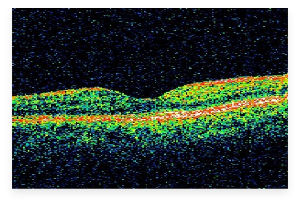 Picture: Illustration of anatomy of an eye with wet AMD, identifying the lens, retina, abnormal leaky blood vessels and increased VEGF-A