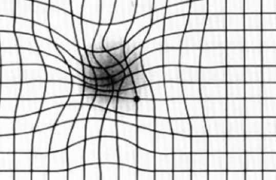 Amsler grid with wavy blurry spot in center demonstrating vision with wet AMD