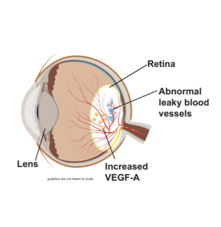 Picture: O.C.T. scan with no visible retinal fluid