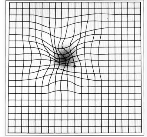 Amsler grid with wavy blurry spot in center demonstrating vision with wet AMD