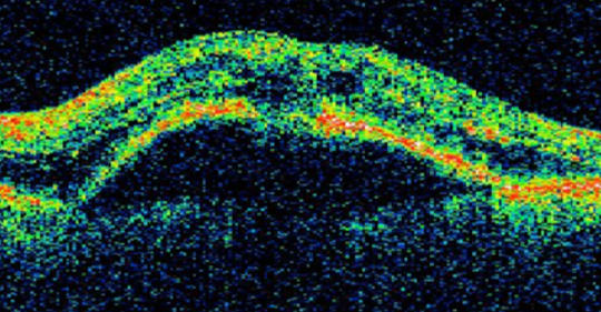 O.C.T of retina with fluid